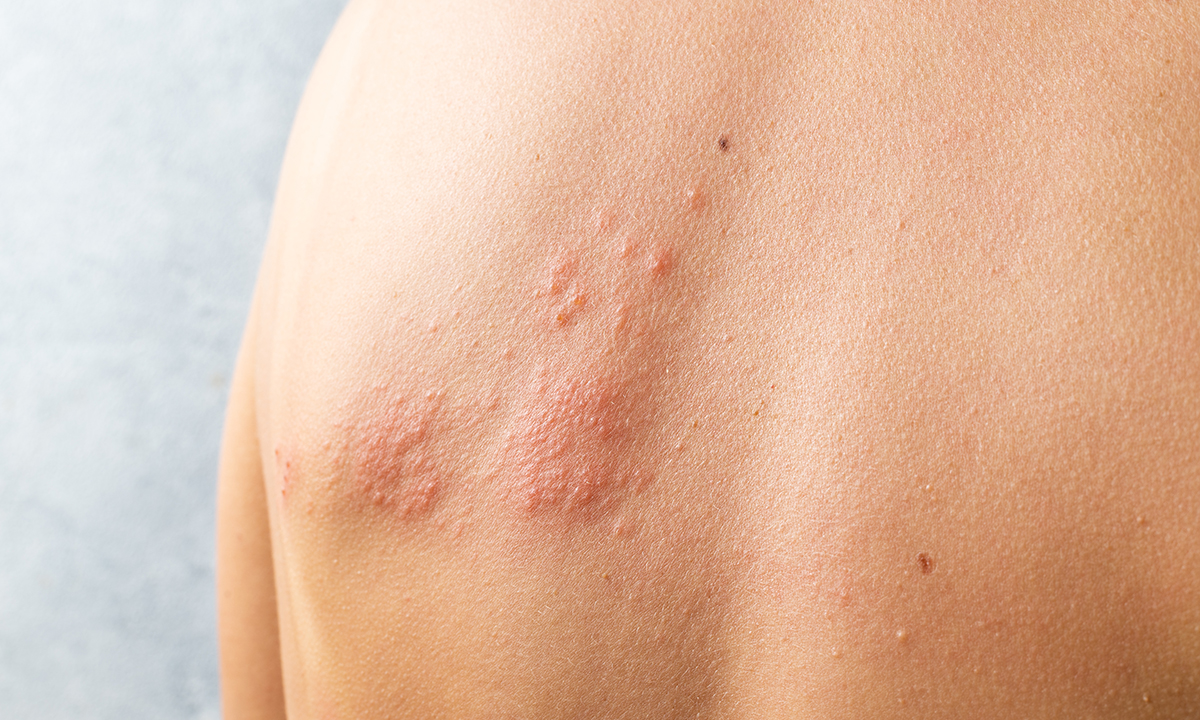 Orticaria da stress - SapereSalute