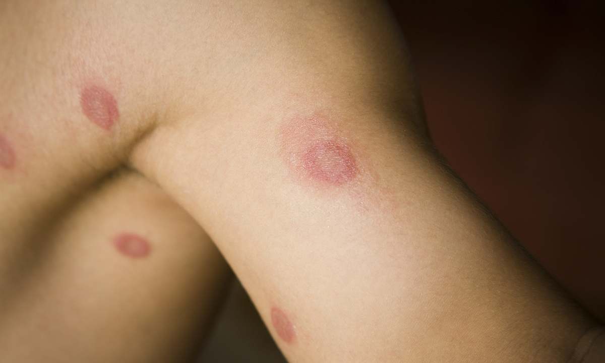 Tutto sulla Tigna - SapereSalute